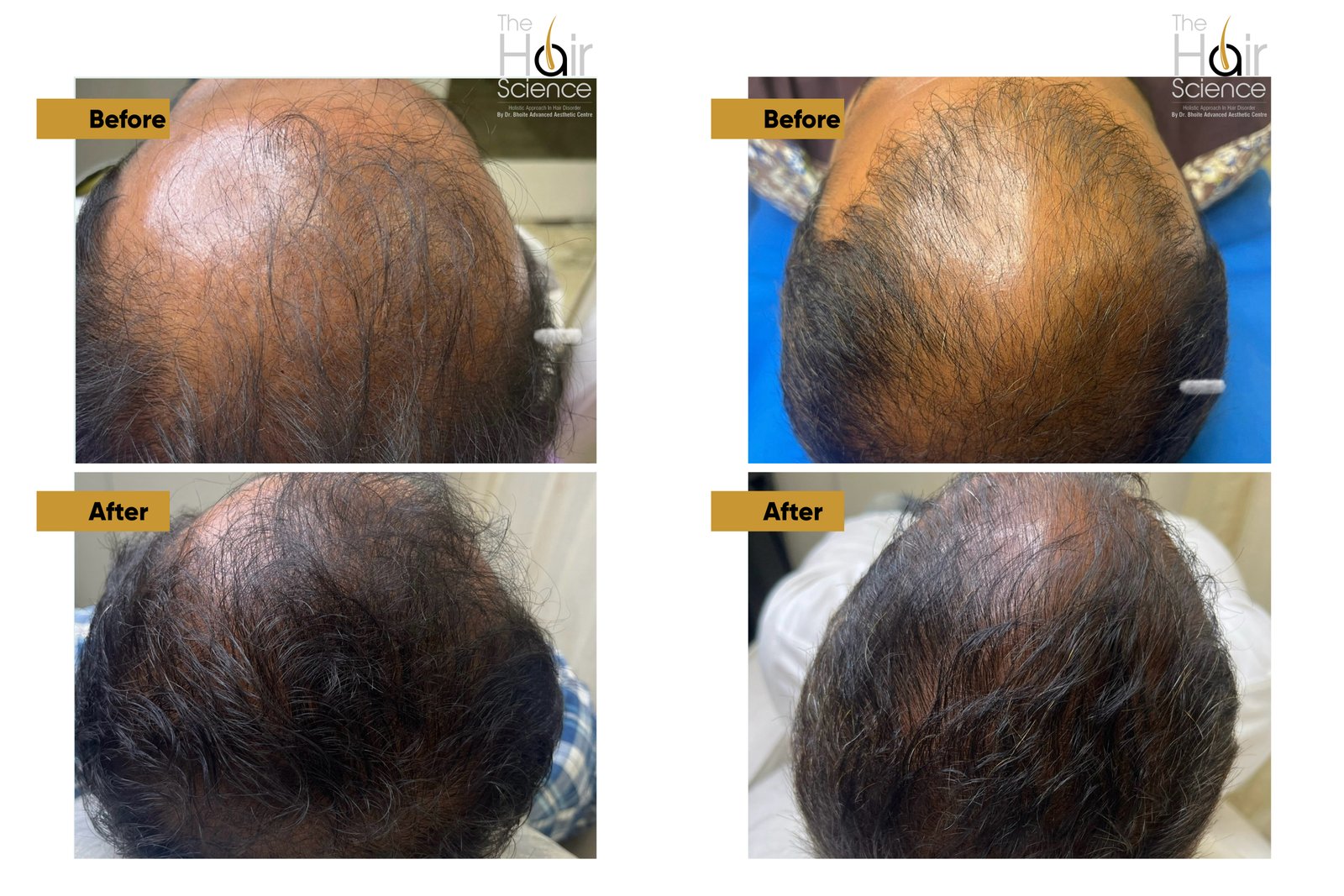 Beard regrowth results