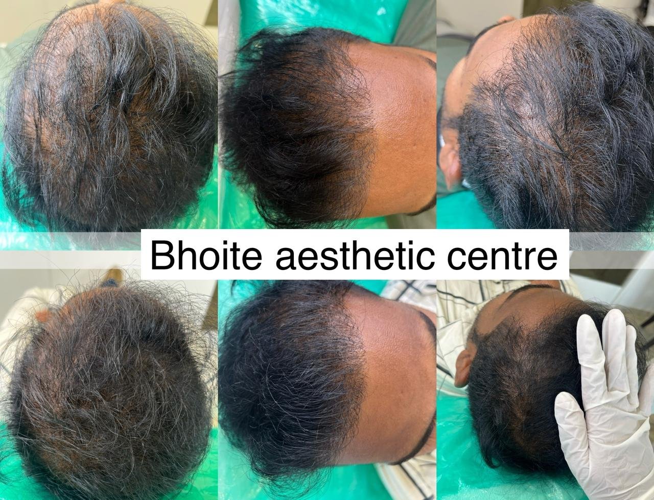 Beard regrowth results