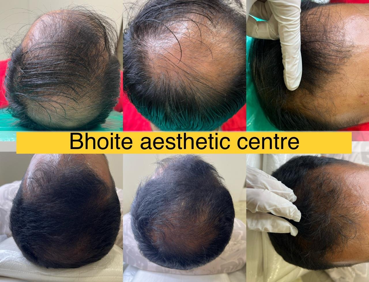 Eyebrow restoration results