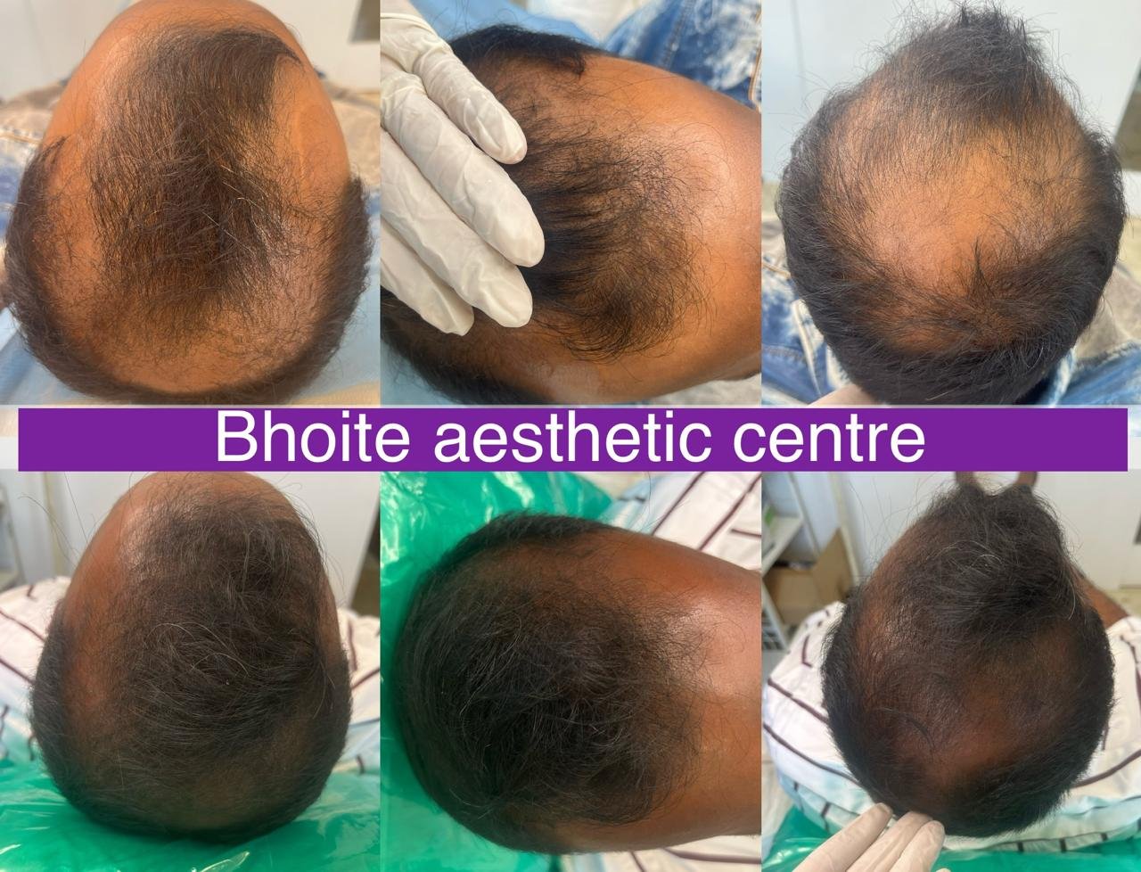 Eyebrow restoration results