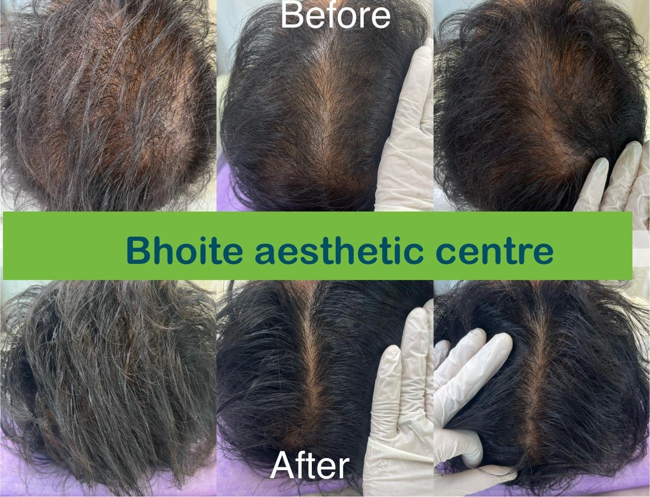 Eyebrow restoration results