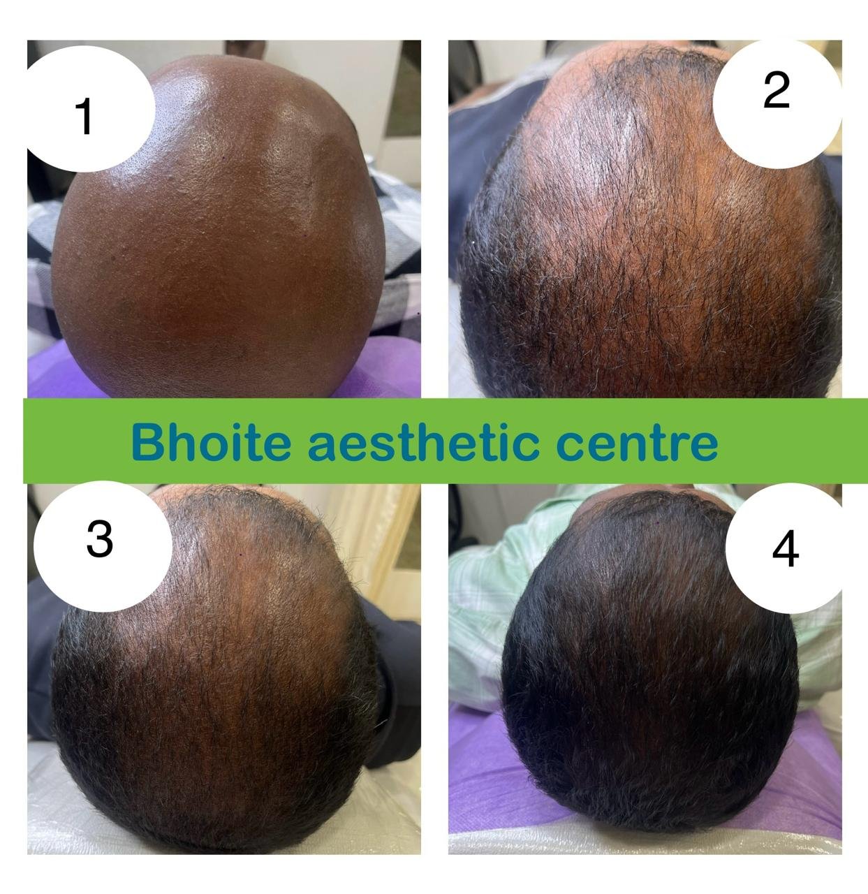 Eyebrow restoration results